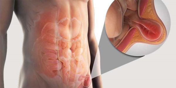 Hérnias da Parede Abdominal - Dr. Mariano de Almeida Menezes